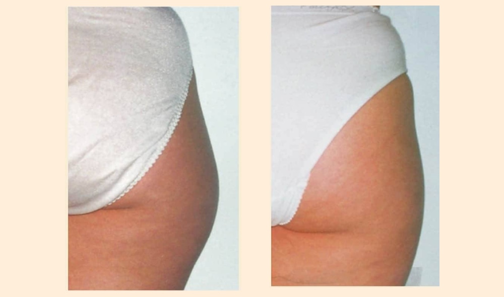 Фото до и после эндосфера терапия уменьшение объемов тела
